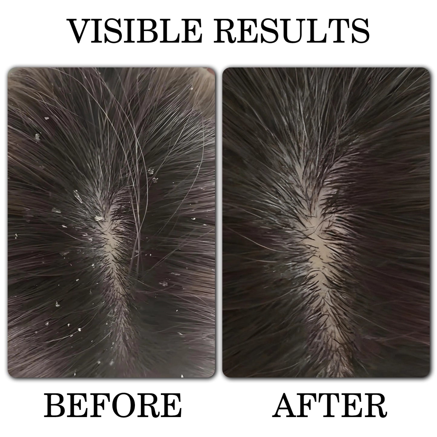 Anti - Dandruff Shampoo
