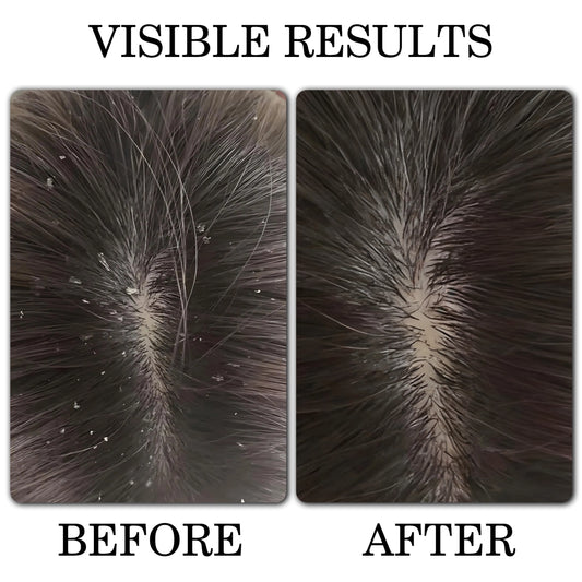 Anti - Dandruff Shampoo