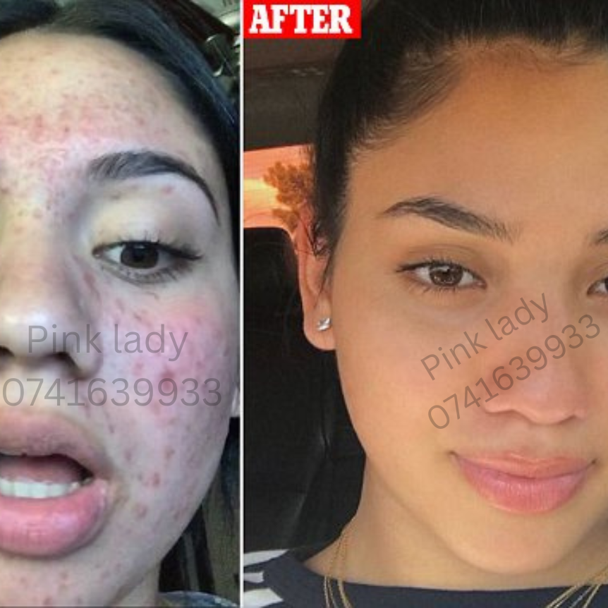 Tea Tree Face Wash For Pimple Skin