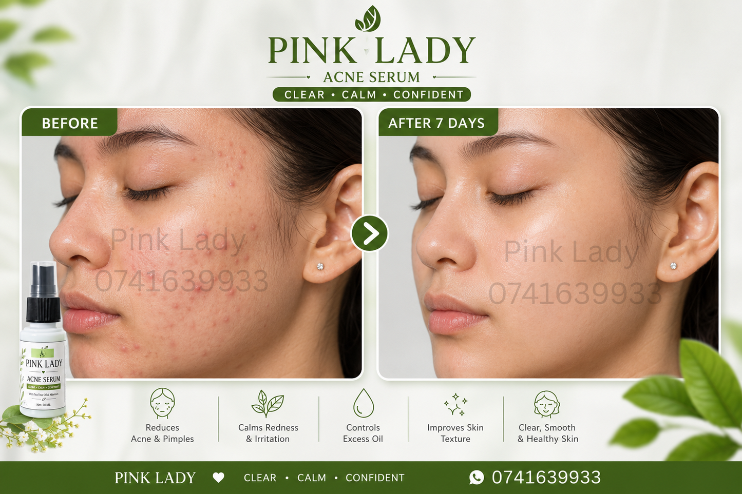 Acne Serum