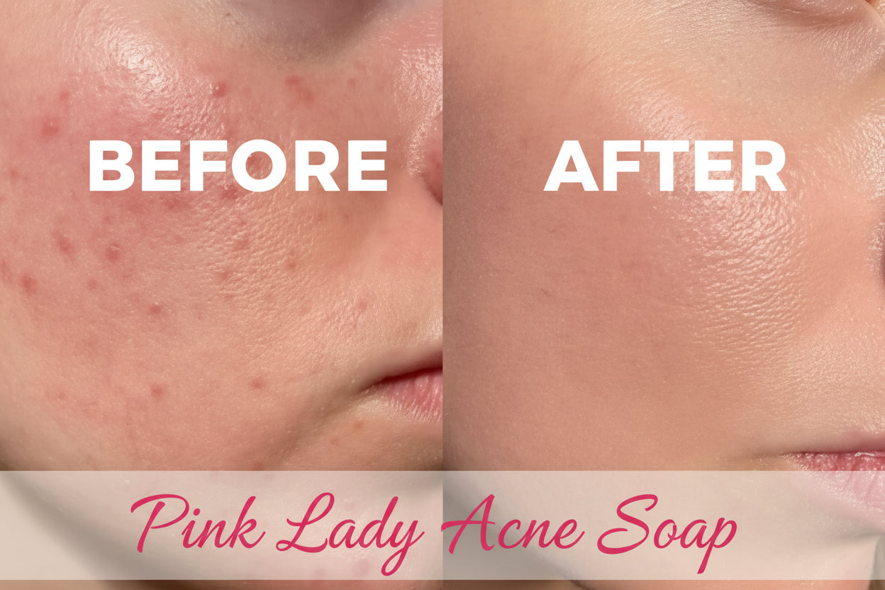 Anti - Acne Soap