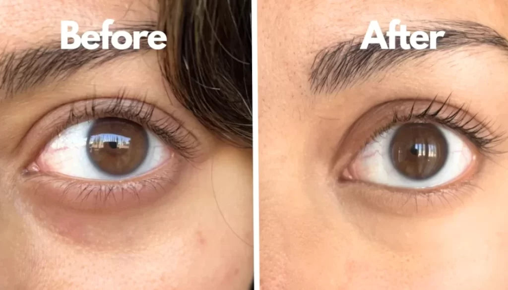 Under-Eye Dark Circles Removing serum