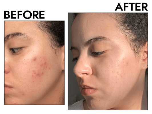 Pimple Pack